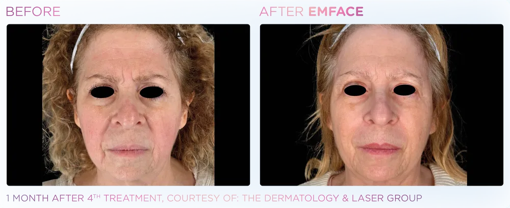 EMFACE female face before & after