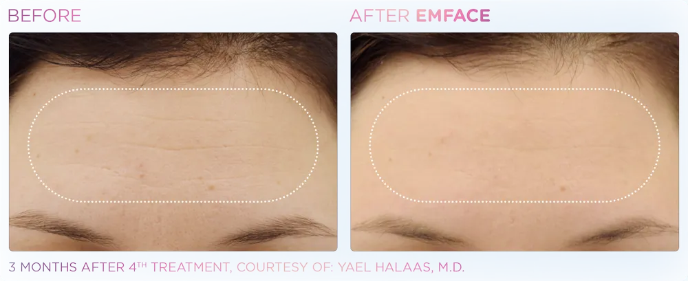 EMFACE female forehead before & after
