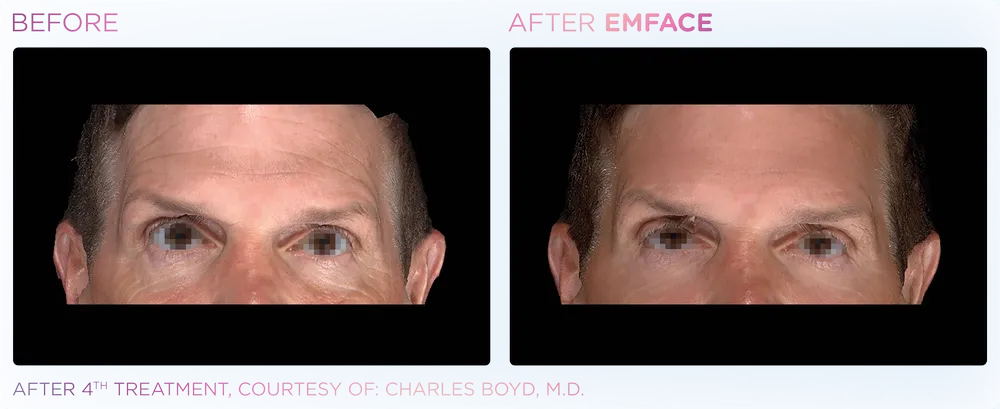 EMFACE male forhead before & after