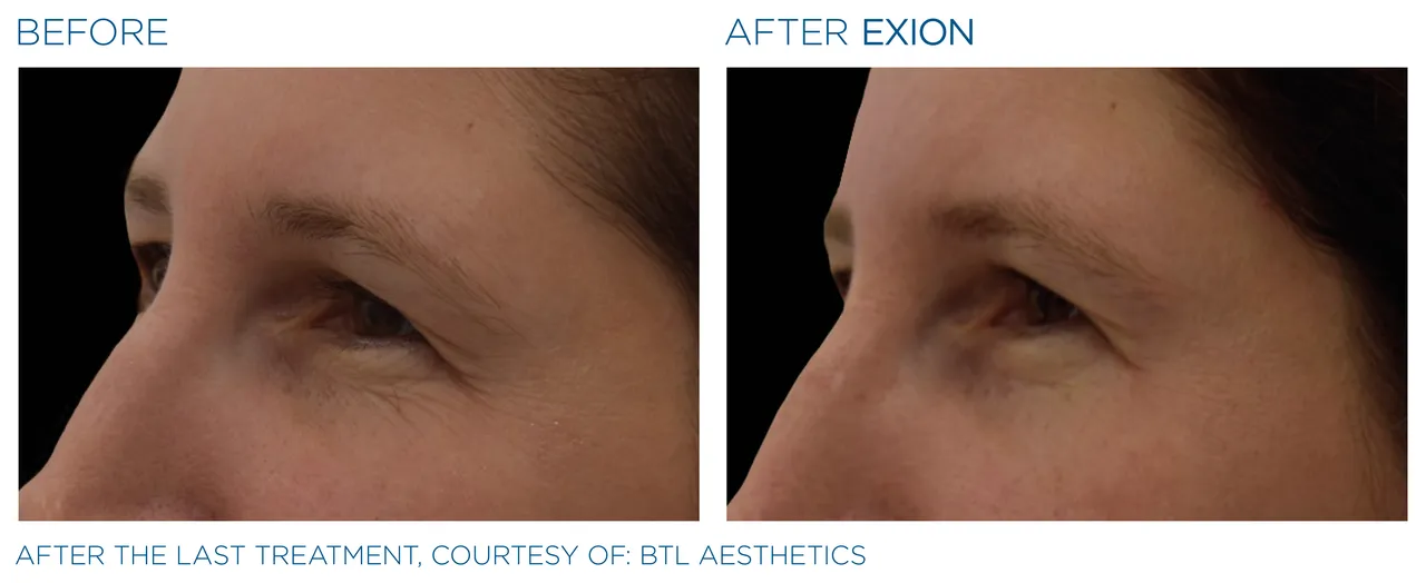 EXION eye area treatment before & after