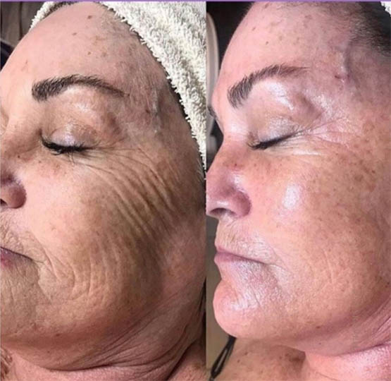 Copy of Before & After Jetpeel